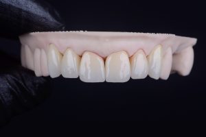 Are Zirconia Crowns the Best Choice for Your Child’s Smile?