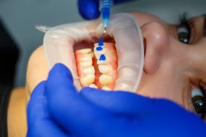 can dental sealants reduce the risk of cavities