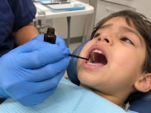 is-silver-diamine-fluoride sdf safe for kids and does it stain teeth